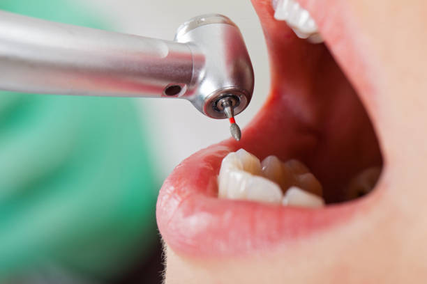 Best Emergency Dental Care for Broken or Chipped Teeth in Lincoln, MO